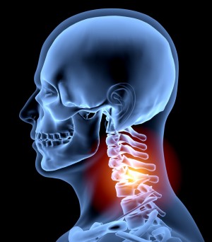 57 year old lady with osteoporosis complaining of persistent neck pain, headaches, migraines and light headedness